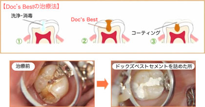 ドックスベストセメント