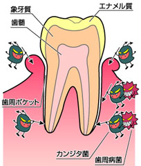歯周病