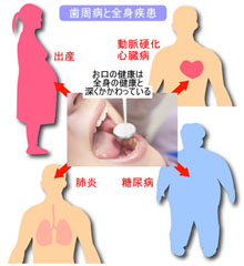 歯周病と全身疾患